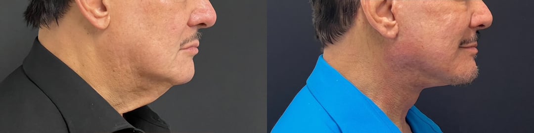 Facelift Before And After Photos By Dr. Demetri Arnaoutakis In Tampa, Fl