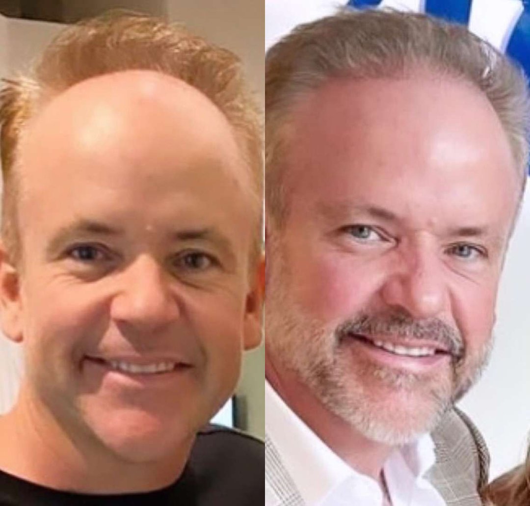 Hair Transplant Before And After Photos By Dr. Demetri Arnaoutakis In Tampa, Fl