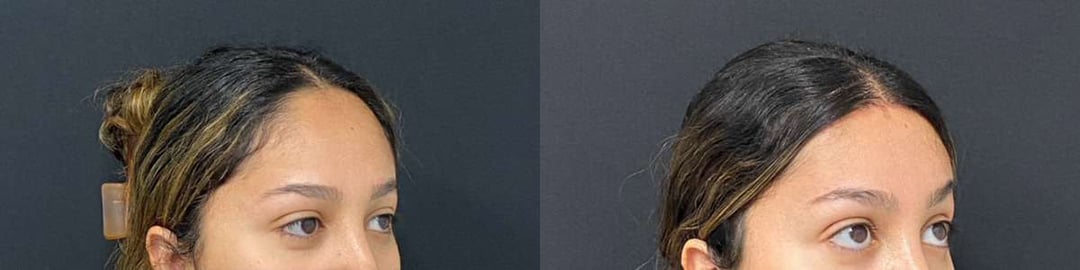 Hairline Lowering Surgery Before And After Photos By Dr. Demetri Arnaoutakis In Tampa, Fl