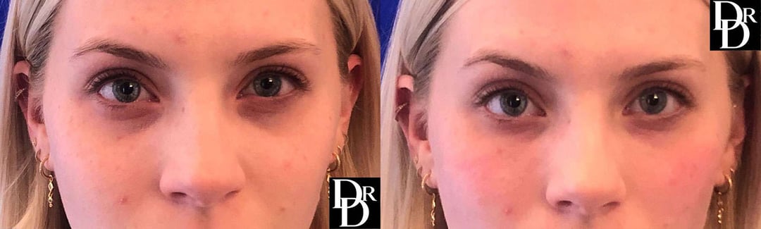 Injectable/Dermal Fillers Before And After Photos By Dr. Demetri Arnaoutakis In Tampa, Fl