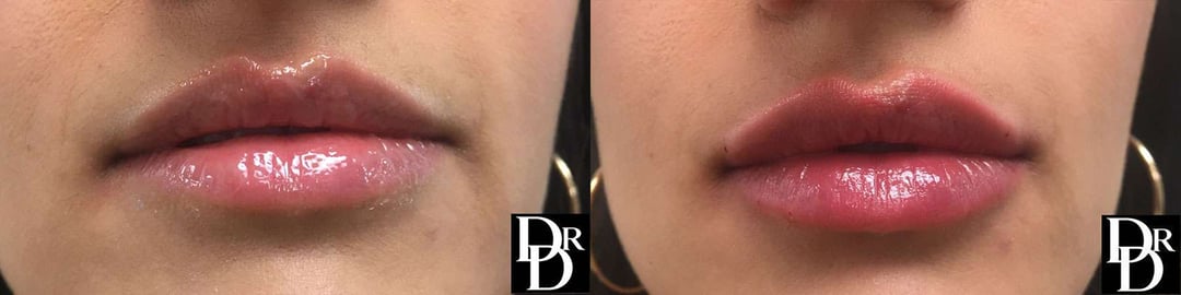 Injectable/Dermal Fillers Before And After Photos By Dr. Demetri Arnaoutakis In Tampa, Fl
