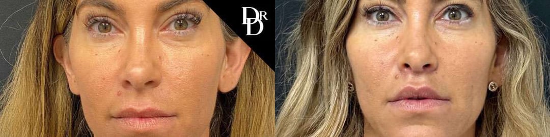 Lip Lift Before And After Photos By Dr. Demetri Arnaoutakis In Tampa, Fl