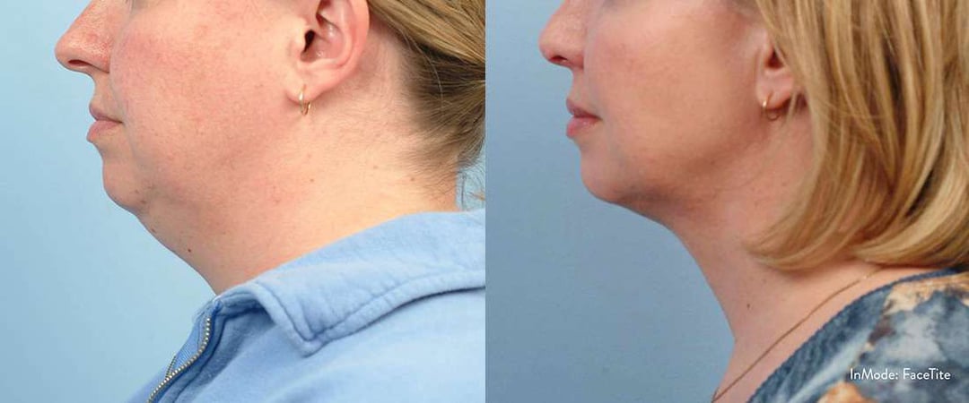 Facetite Before And After Photos By Dr. Demetri Arnaoutakis In Tampa, Fl