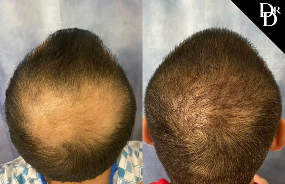 Hair Transplant Before And After Photos By Dr. Demetri Arnaoutakis In Tampa, Fl