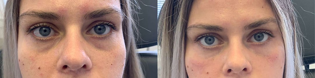 Injectable/Dermal Fillers Before And After Photos By Dr. Demetri Arnaoutakis In Tampa, Fl