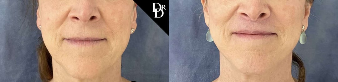 Lip Lift Before And After Photos By Dr. Demetri Arnaoutakis In Tampa, Fl