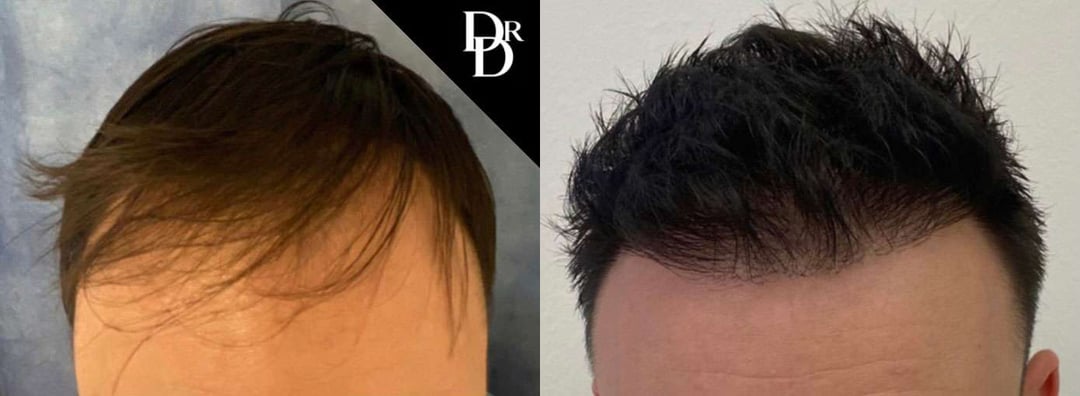 Hair Transplant Before And After Photos By Dr. Demetri Arnaoutakis In Tampa, Fl