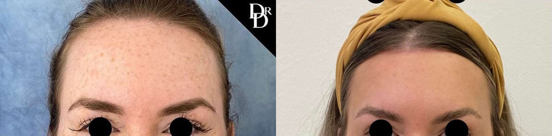 Hairline Lowering Surgery Before And After Photos By Dr. Demetri Arnaoutakis In Tampa, Fl