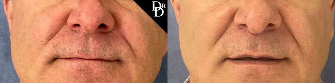 Lip Lift Before And After Photos By Dr. Demetri Arnaoutakis In Tampa, Fl