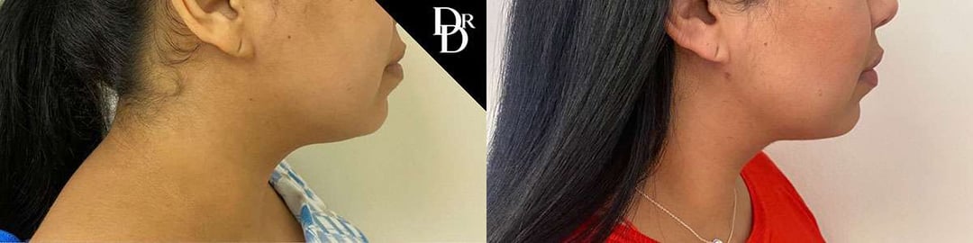 Neck Lift Before And After Photos By Dr. Demetri Arnaoutakis In Tampa, Fl