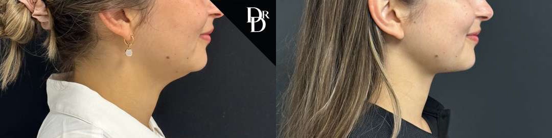 Neck Lift Before And After Photos By Dr. Demetri Arnaoutakis In Tampa, Fl