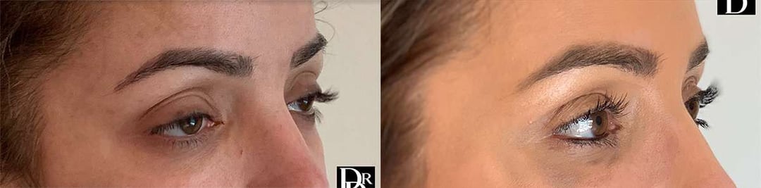 Eyelid Surgery Before And After Photos By Dr. Demetri Arnaoutakis In Tampa, Fl