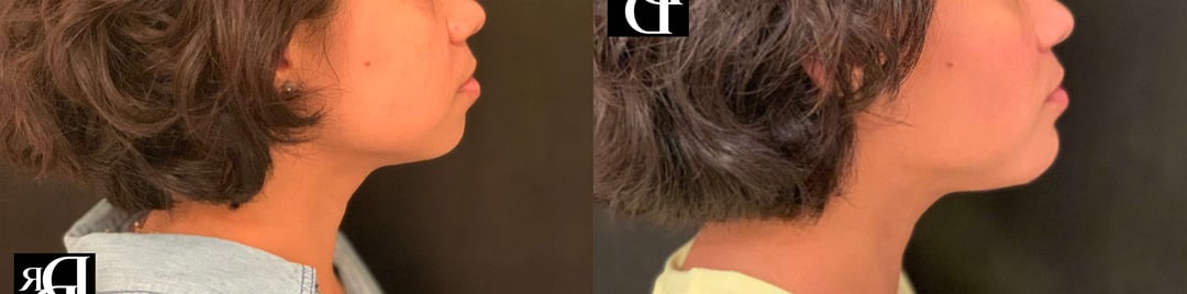Neck Lift Before And After Photos By Dr. Demetri Arnaoutakis In Tampa, Fl