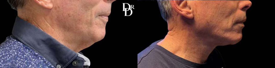 Neck Lift Before And After Photos By Dr. Demetri Arnaoutakis In Tampa, Fl