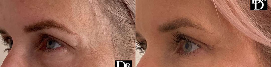 Eyelid Surgery Before And After Photos By Dr. Demetri Arnaoutakis In Tampa, Fl