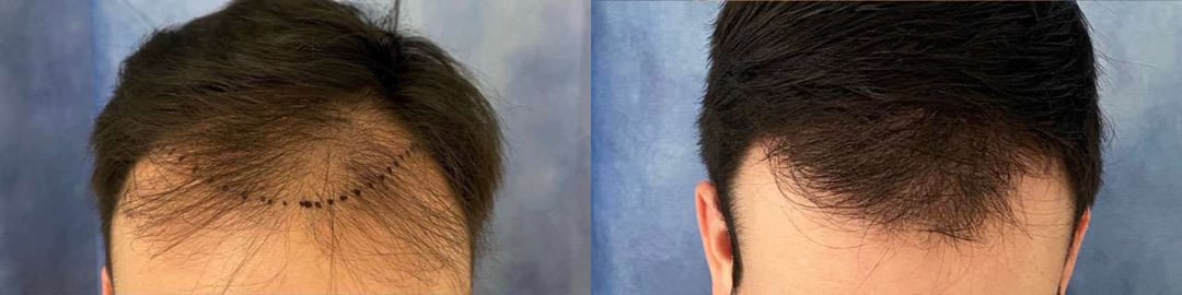 Hair Transplant Before And After Photos By Dr. Demetri Arnaoutakis In Tampa, Fl