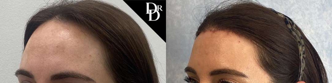 Hairline Lowering Surgery Before And After Photos By Dr. Demetri Arnaoutakis In Tampa, Fl