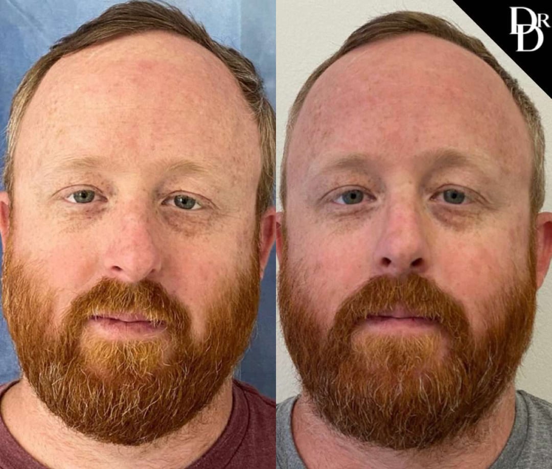 Rhinoplasty Before And After Photos By Dr. Demetri Arnaoutakis In Tampa, Fl