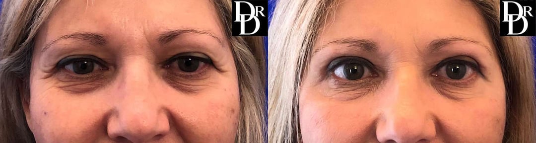 Eyelid Surgery Before And After Photos By Dr. Demetri Arnaoutakis In Tampa, Fl
