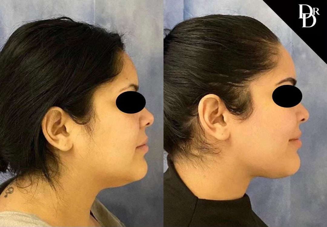 Neck Lift Before And After Photos By Dr. Demetri Arnaoutakis In Tampa, Fl
