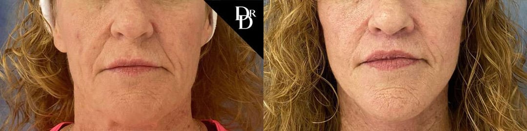 Lip Lift Before And After Photos By Dr. Demetri Arnaoutakis In Tampa, Fl
