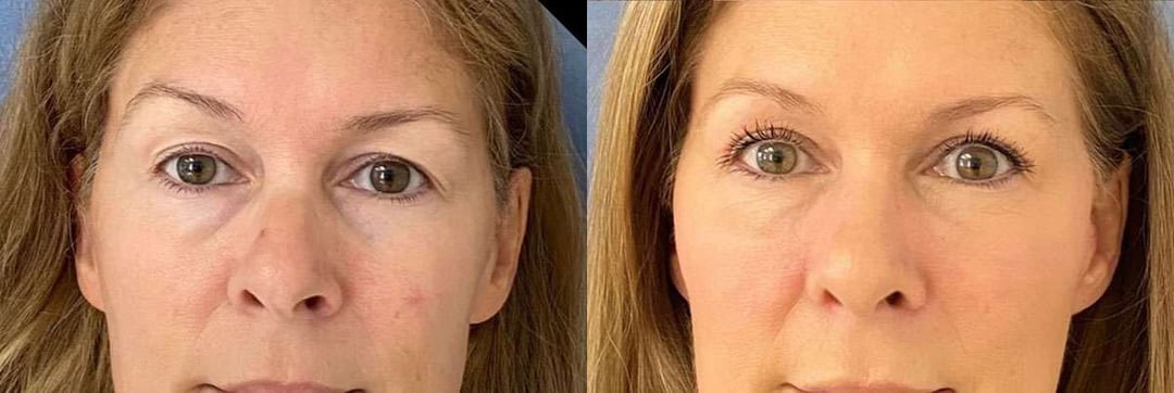Eyelid Surgery Before And After Photos By Dr. Demetri Arnaoutakis In Tampa, Fl