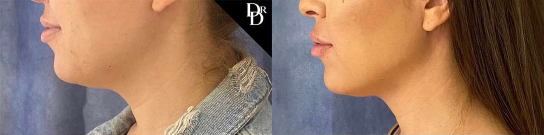 Facetite Before And After Photos By Dr. Demetri Arnaoutakis In Tampa, Fl