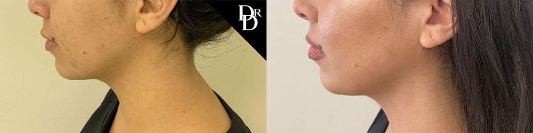 Neck Lift Before And After Photos By Dr. Demetri Arnaoutakis In Tampa, Fl