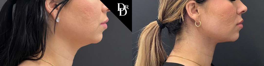 Neck Lift Before And After Photos By Dr. Demetri Arnaoutakis In Tampa, Fl