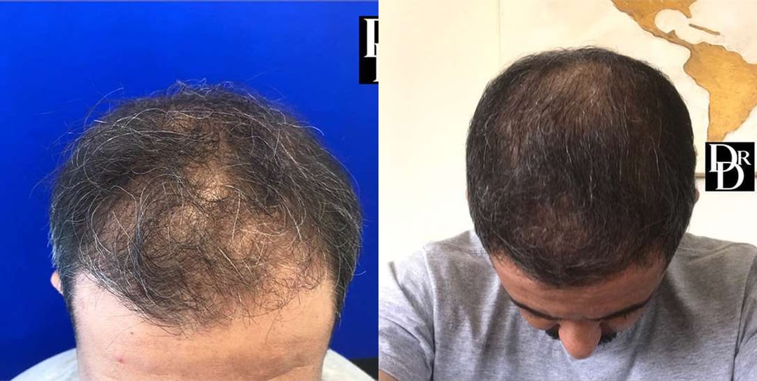 Hair Transplant Before And After Photos By Dr. Demetri Arnaoutakis In Tampa, Fl