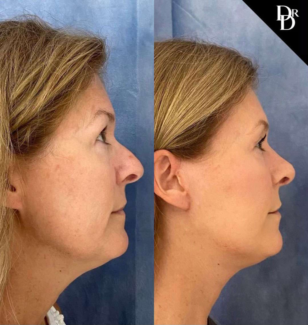 Rhinoplasty Before And After Photos By Dr. Demetri Arnaoutakis In Tampa, Fl