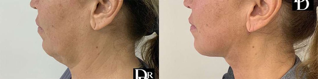Facetite Before And After Photos By Dr. Demetri Arnaoutakis In Tampa, Fl