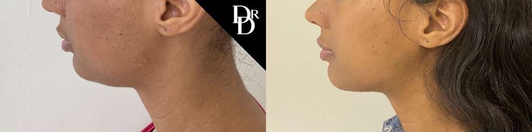 Neck Lift Before And After Photos By Dr. Demetri Arnaoutakis In Tampa, Fl