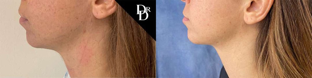 Neck Lift Before And After Photos By Dr. Demetri Arnaoutakis In Tampa, Fl