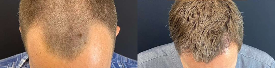 Hair Transplant Before And After Photos By Dr. Demetri Arnaoutakis In Tampa, Fl