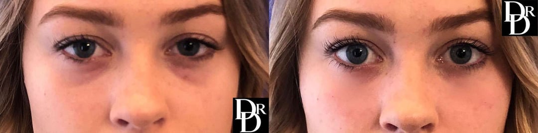 Injectable/Dermal Fillers Before And After Photos By Dr. Demetri Arnaoutakis In Tampa, Fl