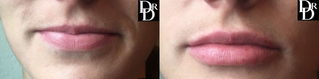 Injectable/Dermal Fillers Before And After Photos By Dr. Demetri Arnaoutakis In Tampa, Fl