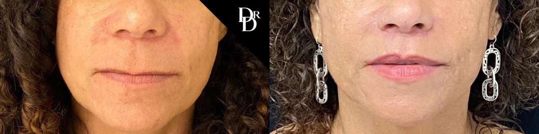 Lip Lift Before And After Photos By Dr. Demetri Arnaoutakis In Tampa, Fl