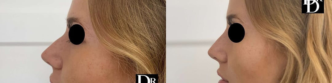 Liquid Rhinoplasty Before And After Photos By Dr. Demetri Arnaoutakis In Tampa, Fl