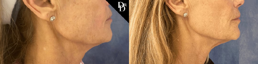 Morpheus8 Before And After Photos By Dr. Demetri Arnaoutakis In Tampa, Fl