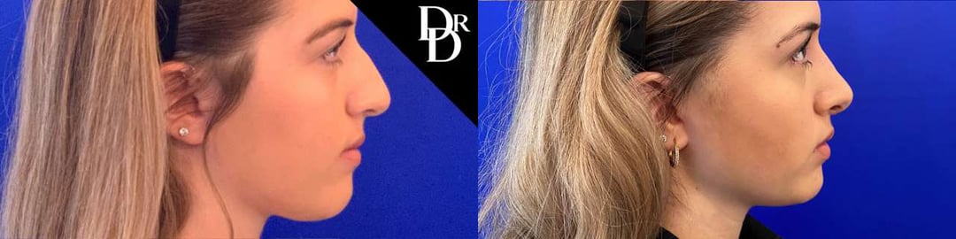 Rhinoplasty Before And After Photos By Dr. Demetri Arnaoutakis In Tampa, Fl