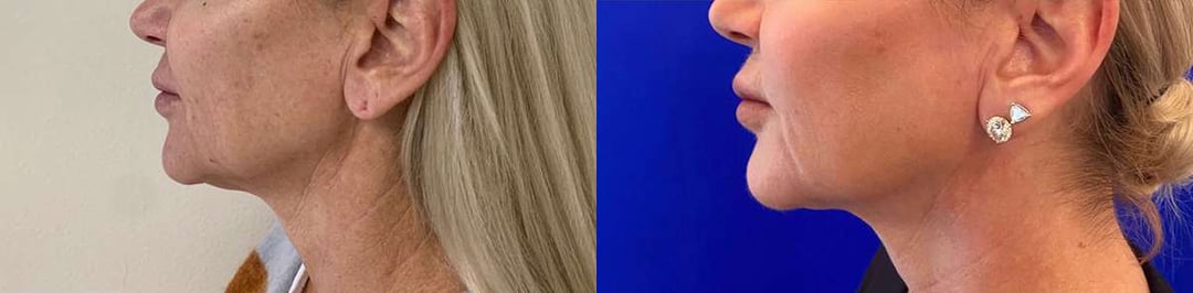 Facetite Before And After Photos By Dr. Demetri Arnaoutakis In Tampa, Fl