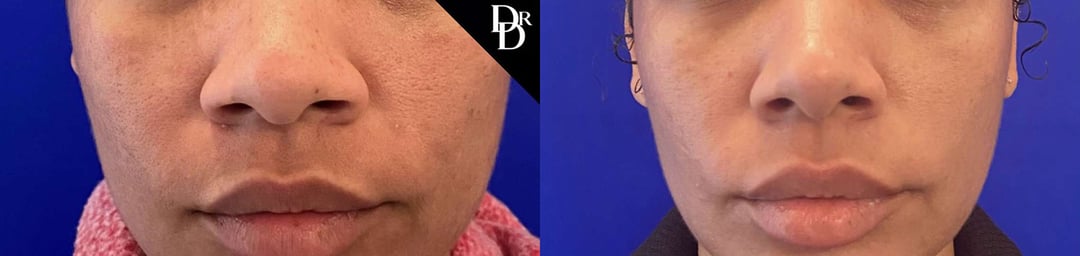 Rhinoplasty Before And After Photos By Dr. Demetri Arnaoutakis In Tampa, Fl