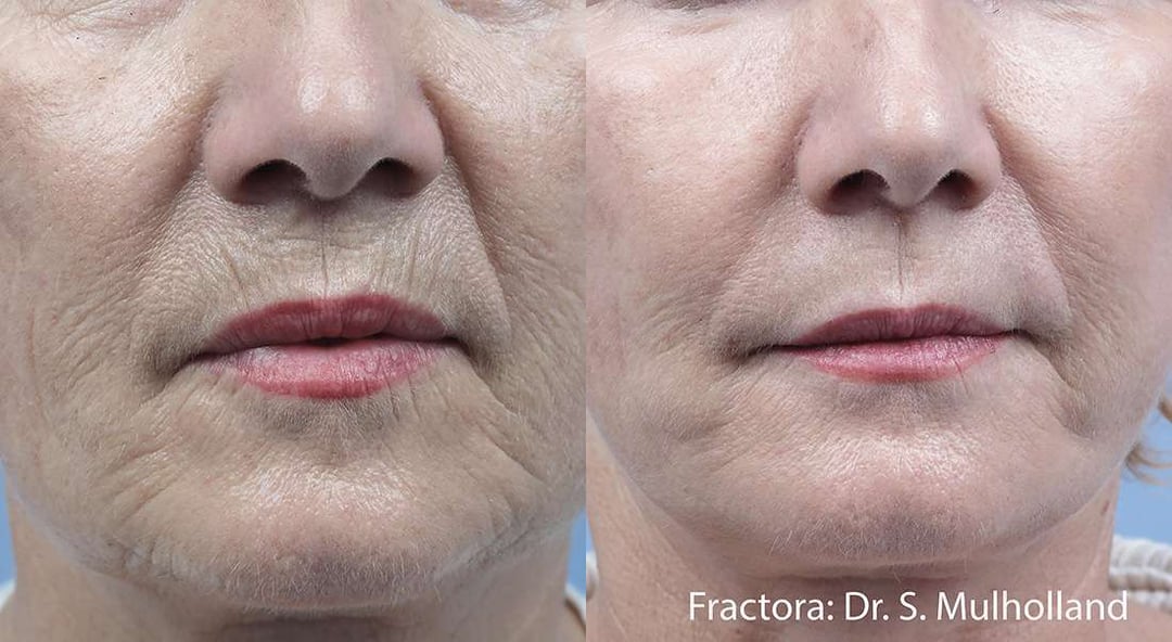 Facetite Before And After Photos By Dr. Demetri Arnaoutakis In Tampa, Fl