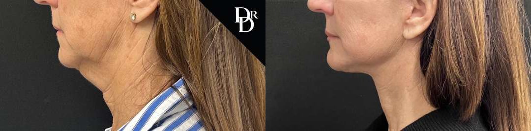 Neck Lift Before And After Photos By Dr. Demetri Arnaoutakis In Tampa, Fl