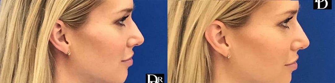 Rhinoplasty Before And After Photos By Dr. Demetri Arnaoutakis In Tampa, Fl