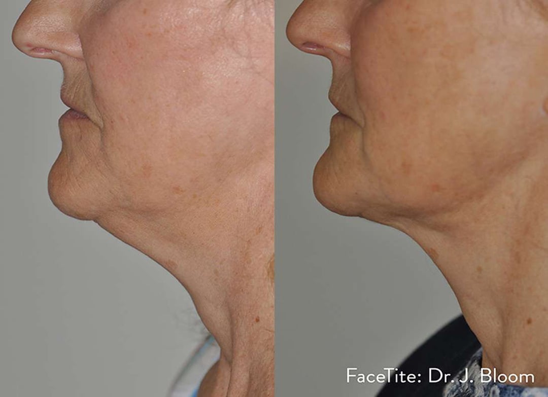 Facetite Before And After Photos By Dr. Demetri Arnaoutakis In Tampa, Fl