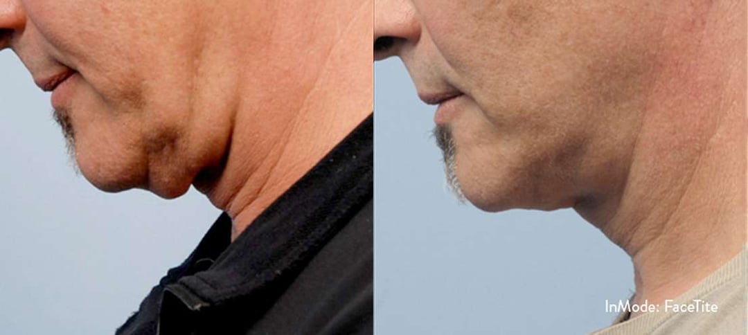 Facetite Before And After Photos By Dr. Demetri Arnaoutakis In Tampa, Fl