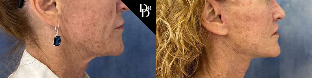 Neck Lift Before And After Photos By Dr. Demetri Arnaoutakis In Tampa, Fl