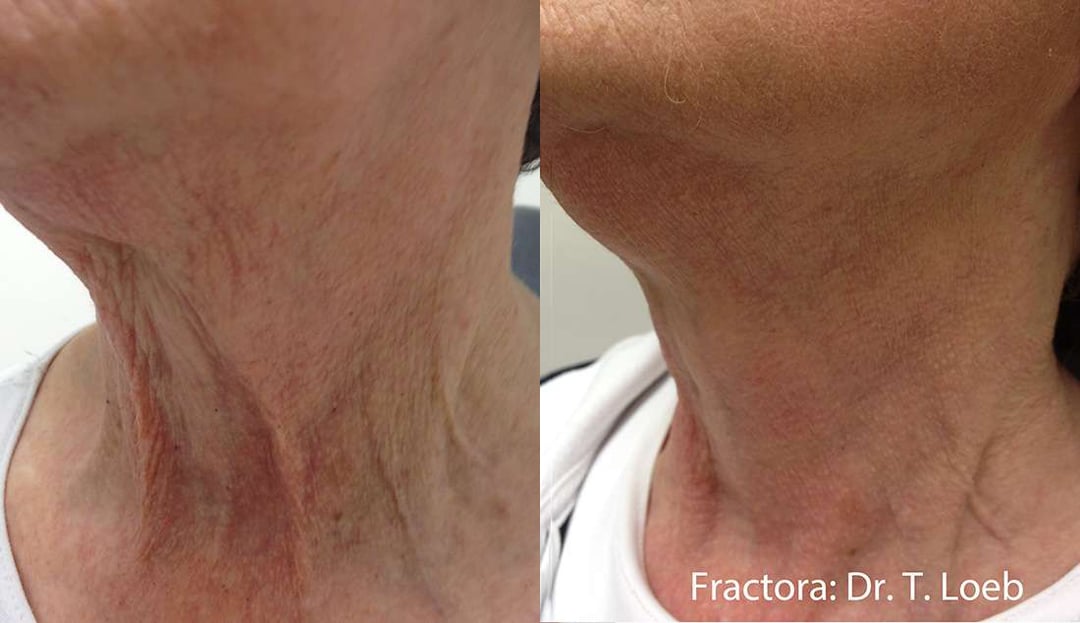 Facetite Before And After Photos By Dr. Demetri Arnaoutakis In Tampa, Fl